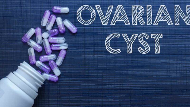 Different Types of Ovarian Cysts and Treatment Options